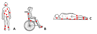 Zones d'ulceració, de la web de l'Institut Català de Salut